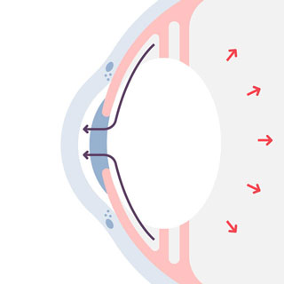 Glaucoma closed angle