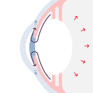 Glaucoma open angle