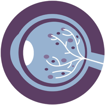 Diabetic Retinopathy inside eye illustration