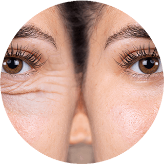 Blepharoplasty