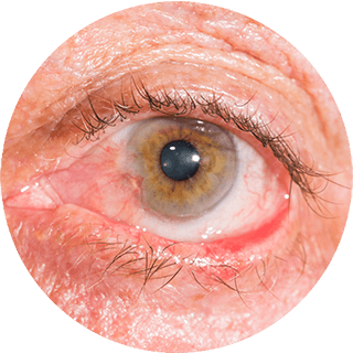 Ectropion repair